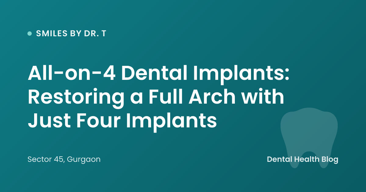 All-on-4 Dental Implants: Restoring a Full Arch with Just Four Implants