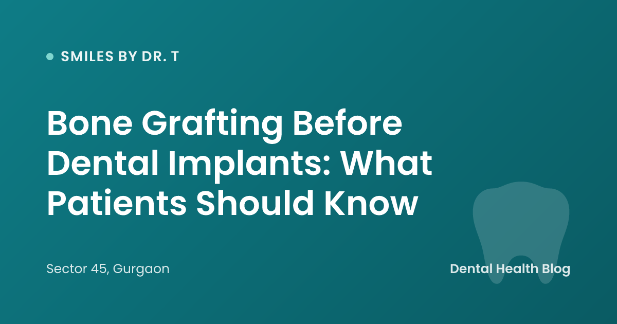 Bone Grafting Before Dental Implants: What Patients Should Know