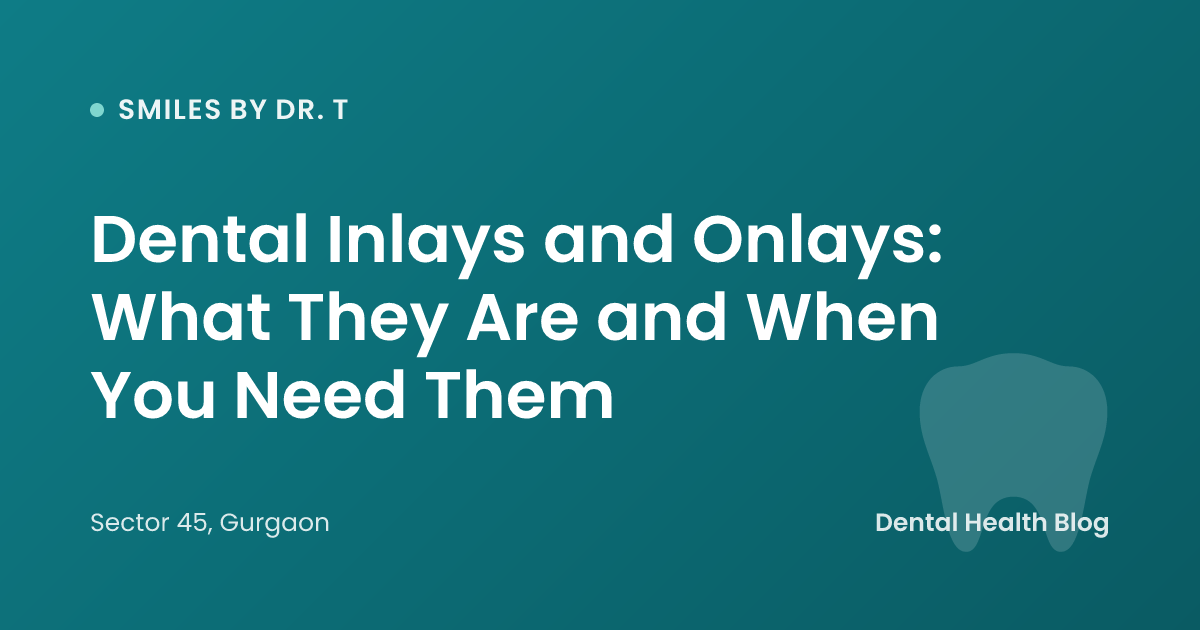 Dental Inlays and Onlays: What They Are and When You Need Them