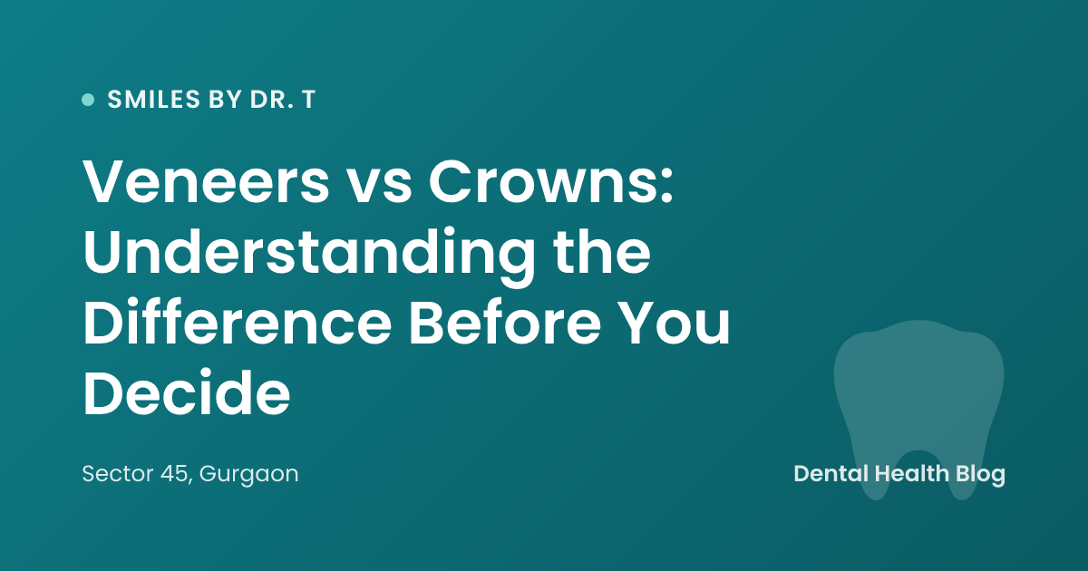 Veneers vs Crowns: Understanding the Difference Before You Decide