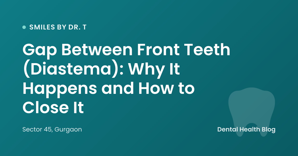 Gap Between Front Teeth (Diastema): Why It Happens and How to Close It