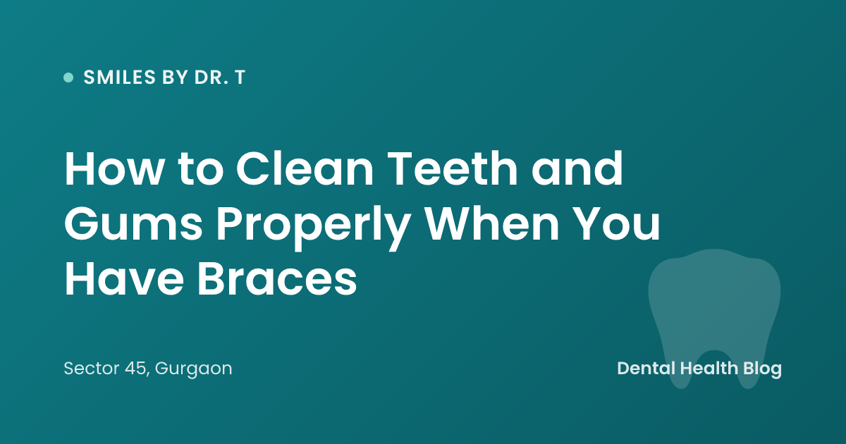 How to Clean Teeth and Gums Properly When You Have Braces