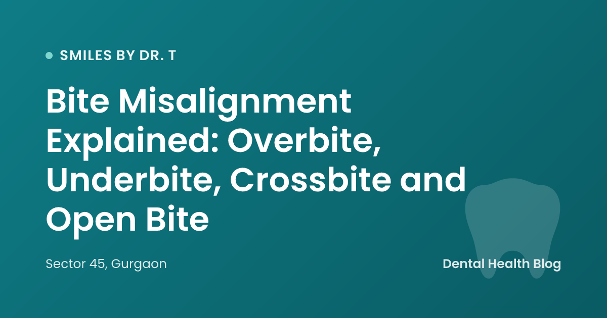 Bite Misalignment Explained: Overbite, Underbite, Crossbite and Open Bite