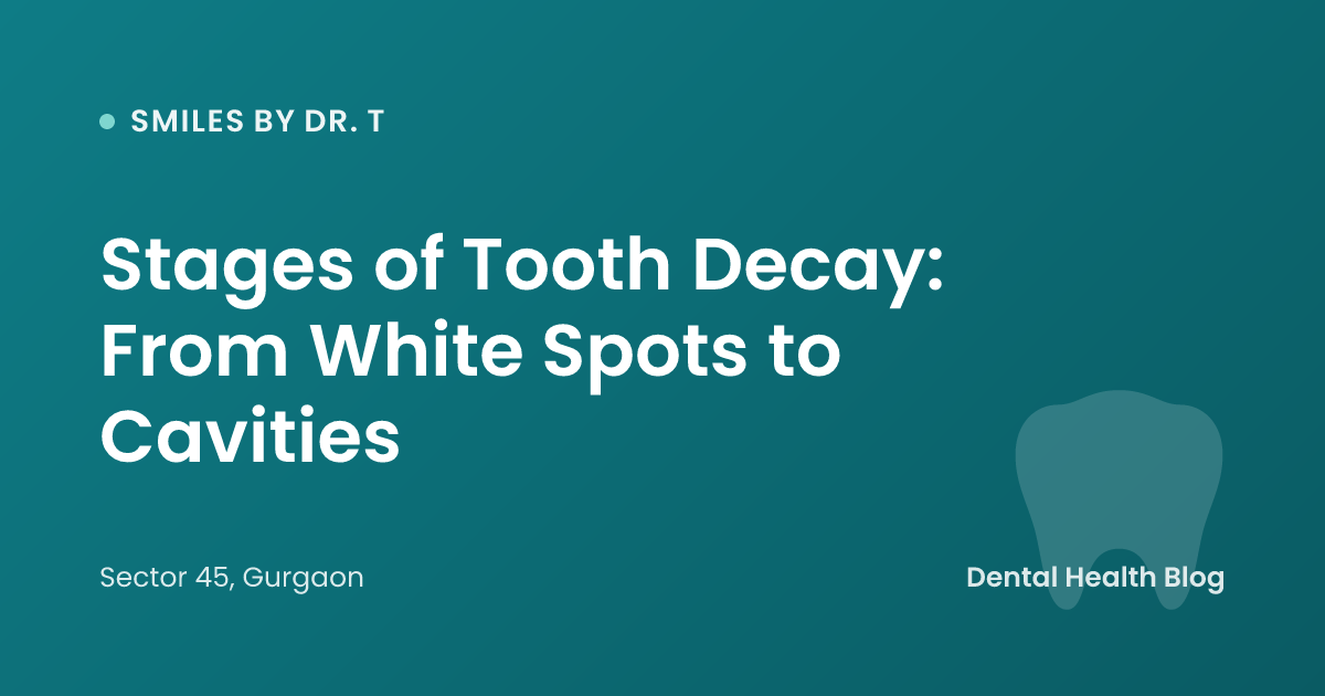 Stages of Tooth Decay: From White Spots to Cavities
